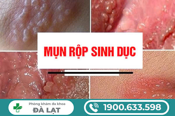DẤU HIỆU MỤN RỘP SINH DỤC Ở CẢ NAM VÀ NỮ -  TÌM HIỂU NGAY ĐỂ KỊP THỜI THĂM KHÁM VÀ ĐIỀU TRỊ