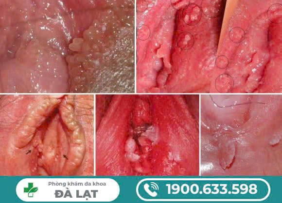 ÂM ĐẠO NỔI MỤN LI TI? PHƯƠNG PHÁP ĐIỀU TRỊ HIỆU QUẢ NHẤT?