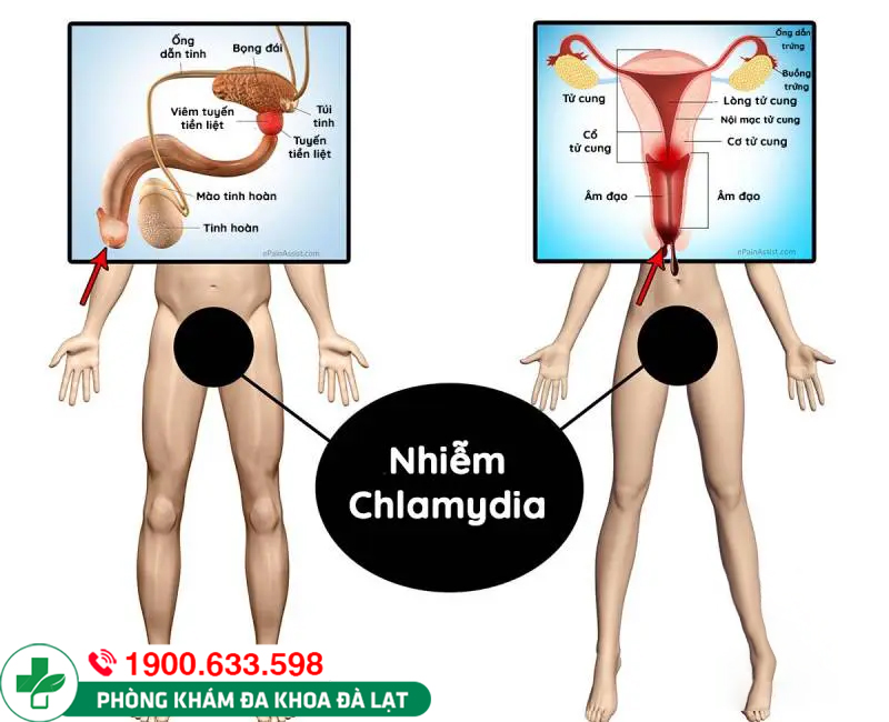 Bệnh Chlamydia ở nữ: dấu hiệu nhận biết, biến chứng nguy hiểm