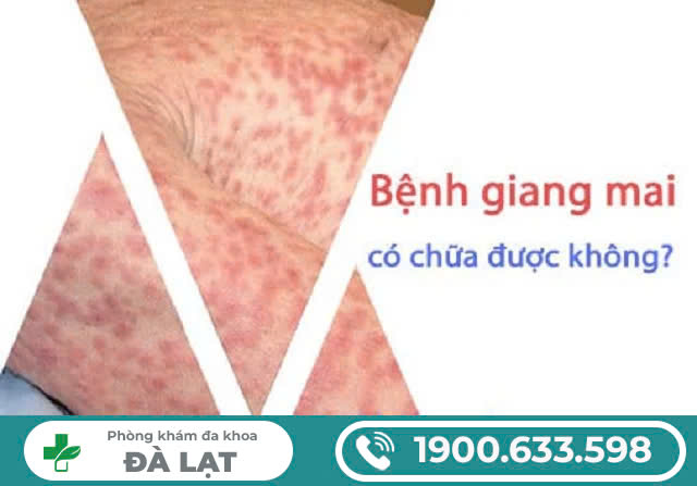 BỆNH GIANG MAI CÓ CHỮA ĐƯỢC KHÔNG? GIANG MAI CÓ TÁI PHÁT KHÔNG?