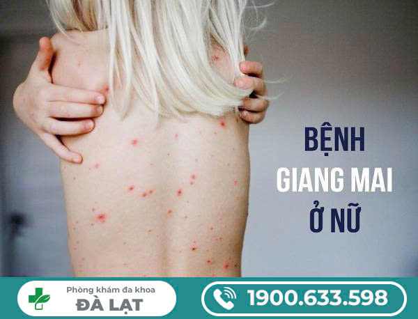 GIANG MAI Ở NỮ GIỚI: NGUYÊN NHÂN, DẤU HIỆU VÀ CÁCH ĐIỀU TRỊ