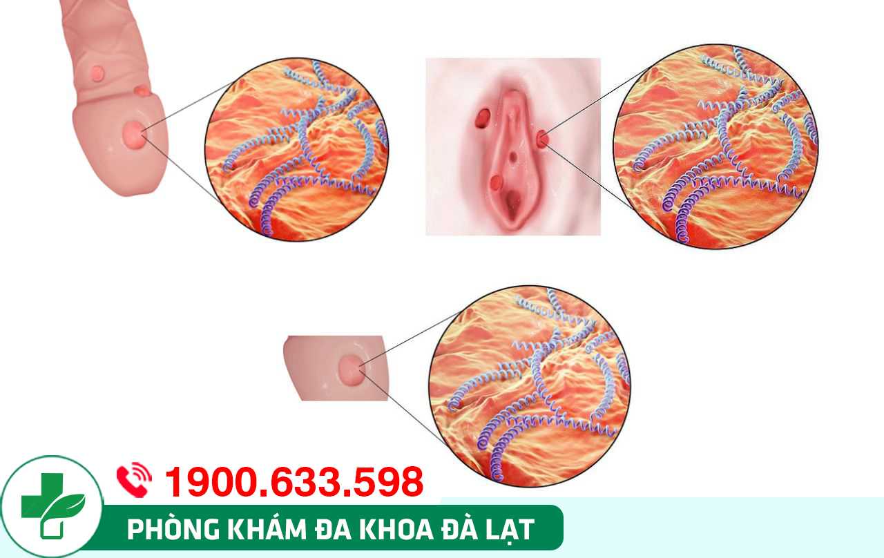 THỜI GIAN Ủ BỆNH GIANG MAI LÀ BAO LÂU?