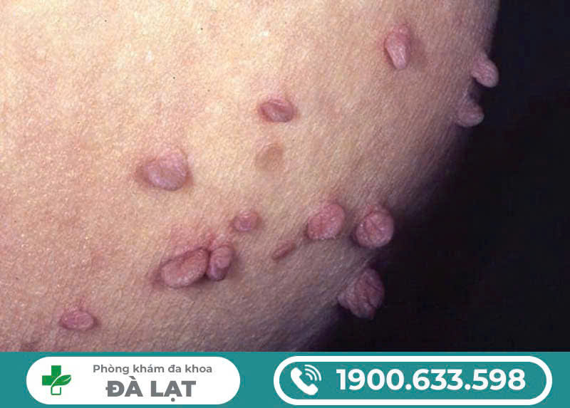 NGUYÊN NHÂN MỌC MỤN CÓC SINH DỤC Ở CẬU NHỎ? PHƯƠNG PHÁP ĐIỀU TRỊ HIỆU QUẢ NHẤT