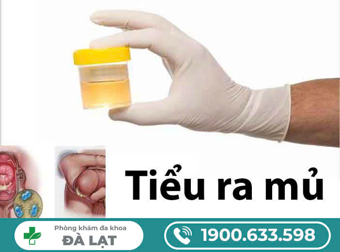 Tiểu buốt có mủ: Dấu hiệu cảnh báo bệnh lý nguy hiểm?