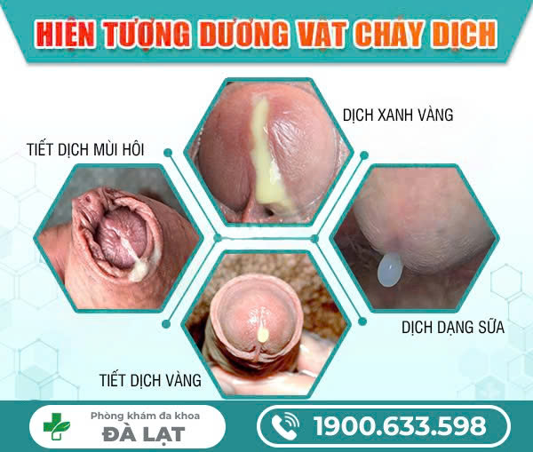 Dương Vật Chảy Dịch? Dấu Hiệu Cảnh Báo Bệnh Nam Khoa Không Nên Chủ Quan