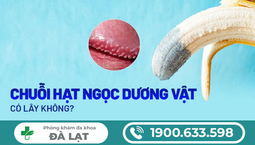 CHUỖI HẠT NGỌC CÓ LÂY KHÔNG? DẤU HIỆU NHẬN BIẾT VÀ CÁCH ĐIỀU TRỊ