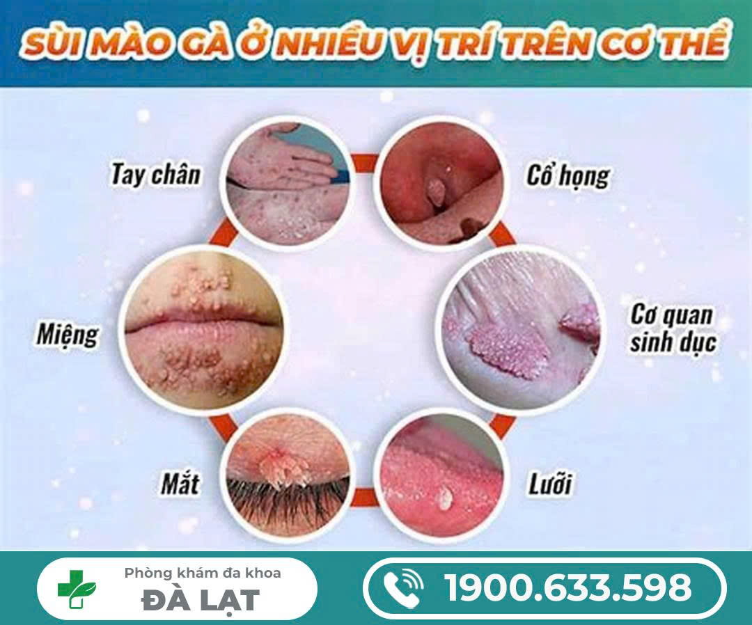 ĐỐT SÙI MÀO GÀ LÀ GÌ? CHI PHÍ ĐIỀU TRỊ SÙI MÀO GÀ