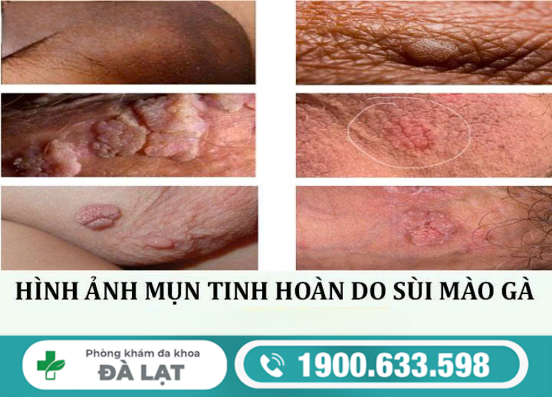 TÌM HIỂU BỆNH SÙI MÀO GÀ Ở TINH HOÀN VÀ CÁCH ĐIỀU TRỊ 