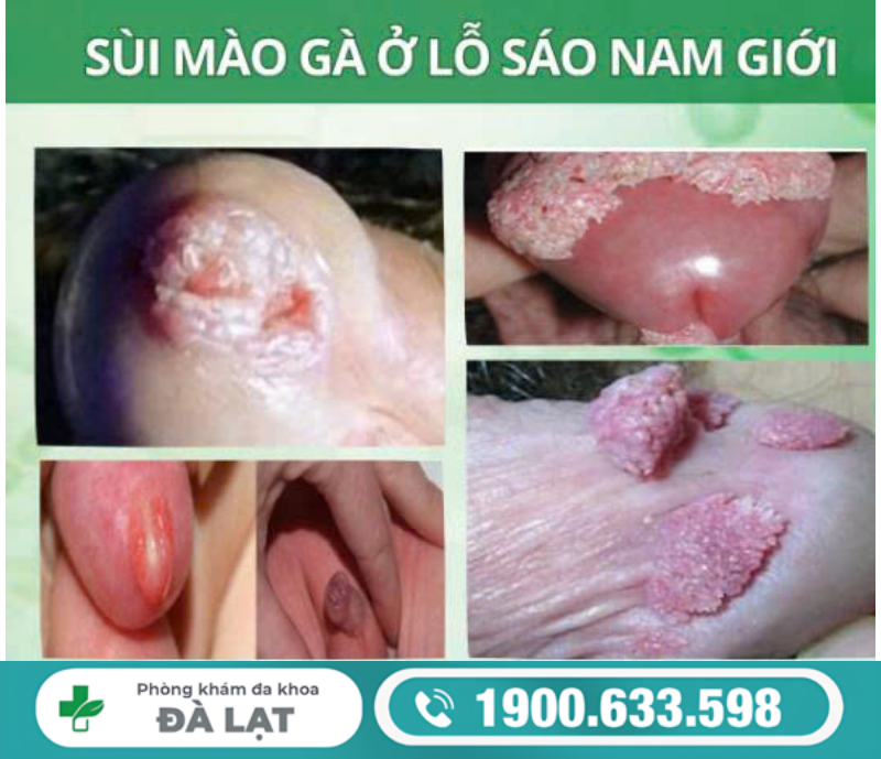 BỆNH SÙI MÀO GÀ Ở LỖ SÁO: NGUYÊN NHÂN VÀ CÁCH ĐIỀU TRỊ HIỆU QUẢ 