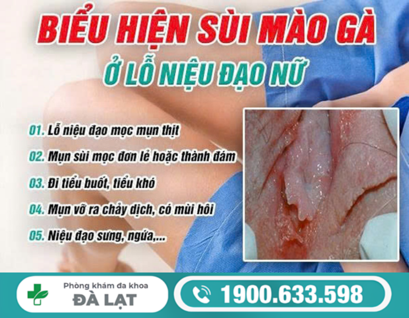 TÌM HIỂU BỆNH SÙI MÀO GÀ Ở LỖ NIỆU ĐẠO NỮ GIỚI