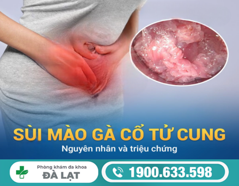 TÌM HIỂU VỀ BỆNH SÙI MÀO GÀ Ở CỔ TỬ CUNG VÀ CÁCH ĐIỀU TRỊ 