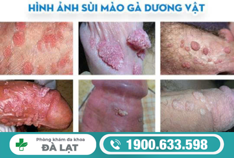 TÌM HIỂU VỀ BỆNH SÙI MÀO GÀ Ở DÂY HÃM