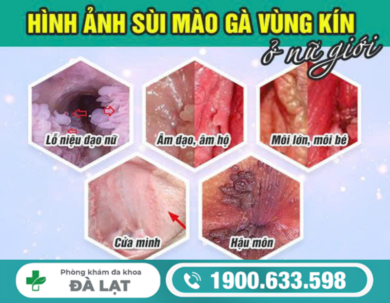 TÌM HIỂU VỀ BỆNH SÙI MÀO GÀ Ở CỬA MÌNH NỮ GIỚI