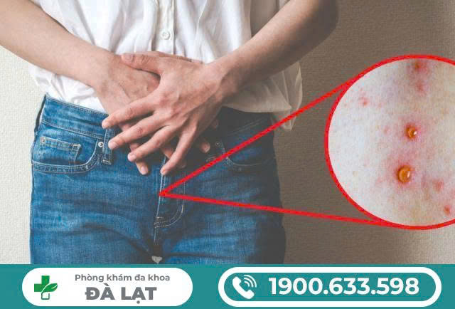 Nổi Nốt Có Mủ: Nguyên Nhân, Triệu Chứng và Cách Điều Trị 