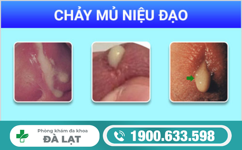 Niệu Đạo Chảy Mủ Là Gì? Cách Điều Trị Niệu Đạo Chảy Mủ 
